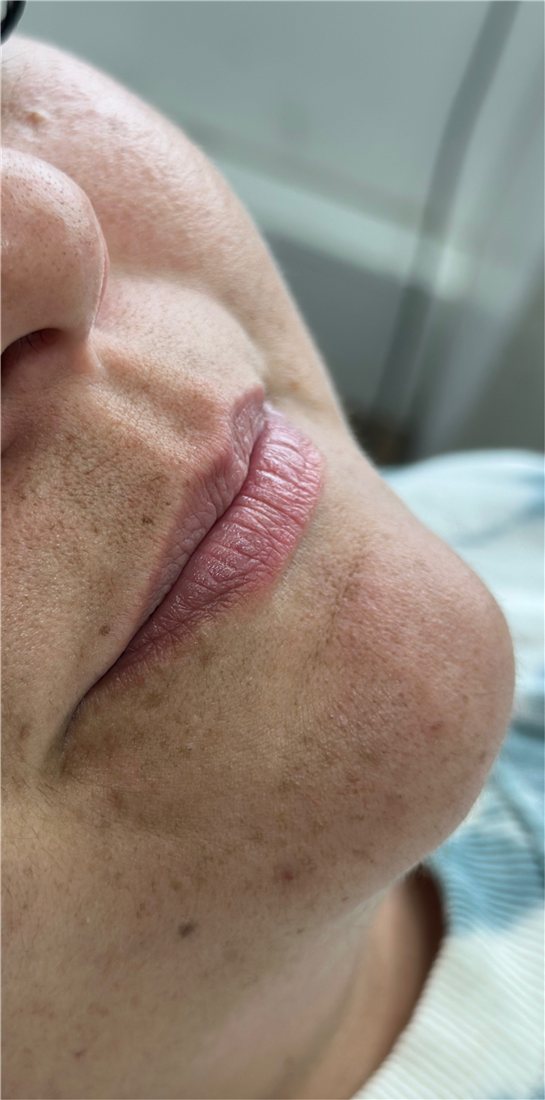 Labios antes del relleno con ácido hialurónico