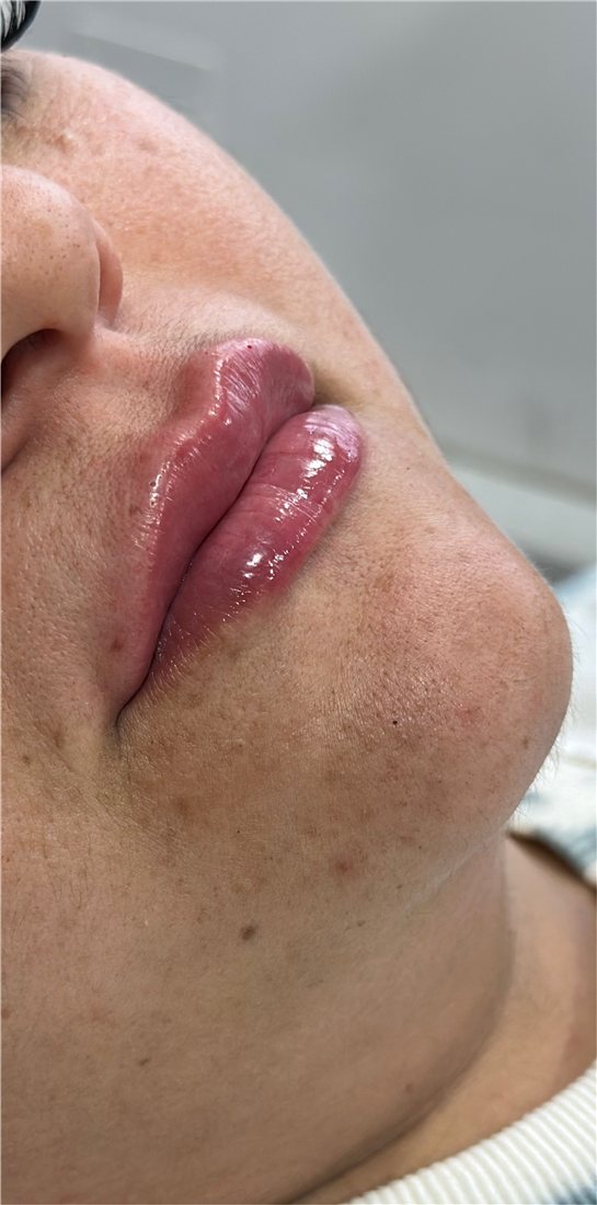 Labios después del relleno con ácido hialurónico