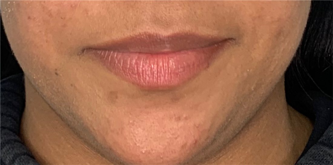 Labios antes del relleno, vista frontal