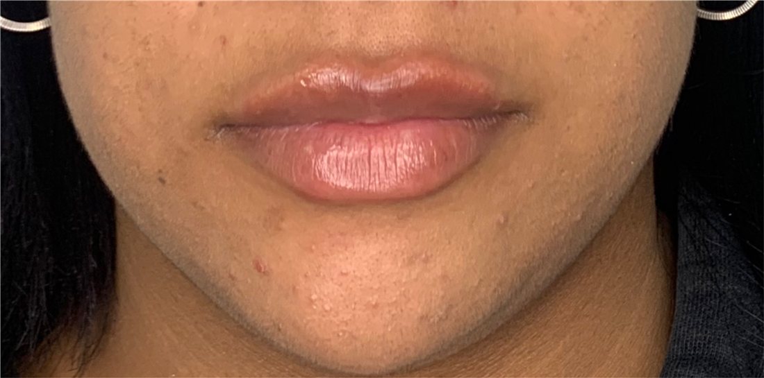 Labios después del relleno, vista frontal