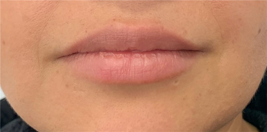 Labios antes del perfilado sutil