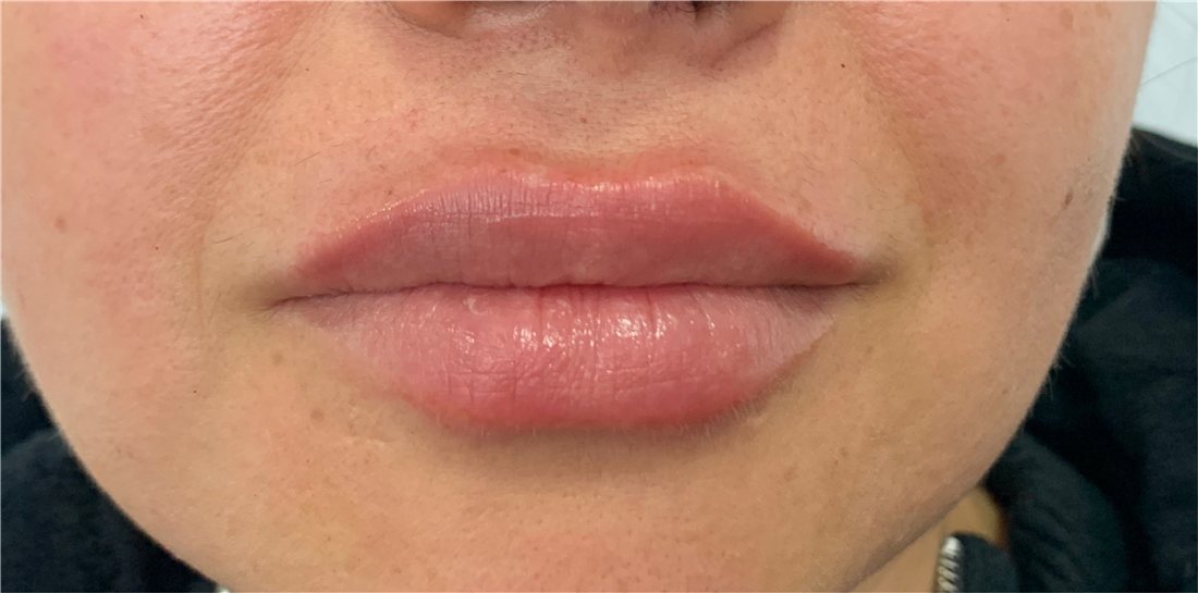 Labios después del perfilado sutil