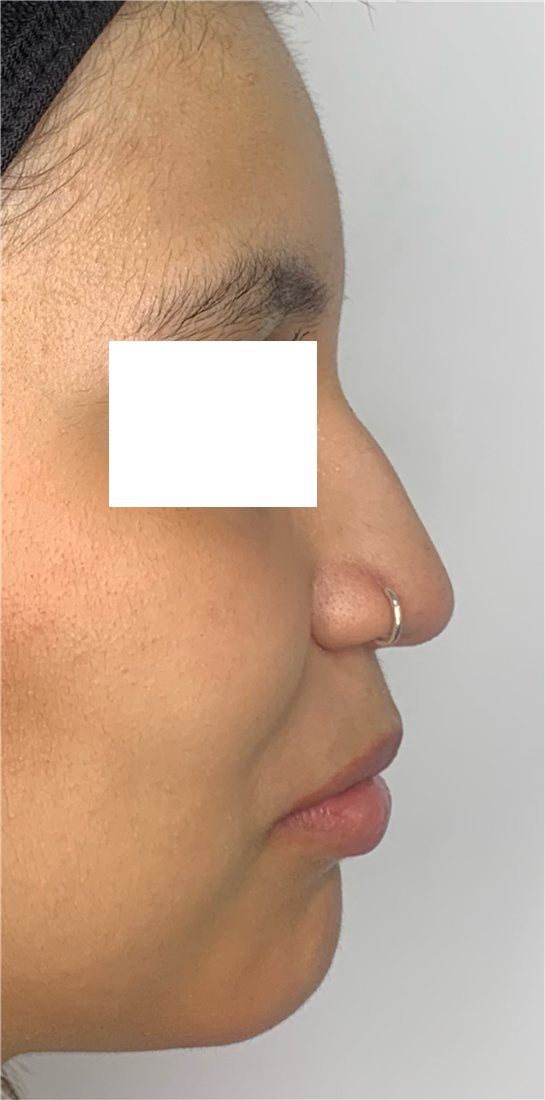 Perfil antes de la rinomodelación