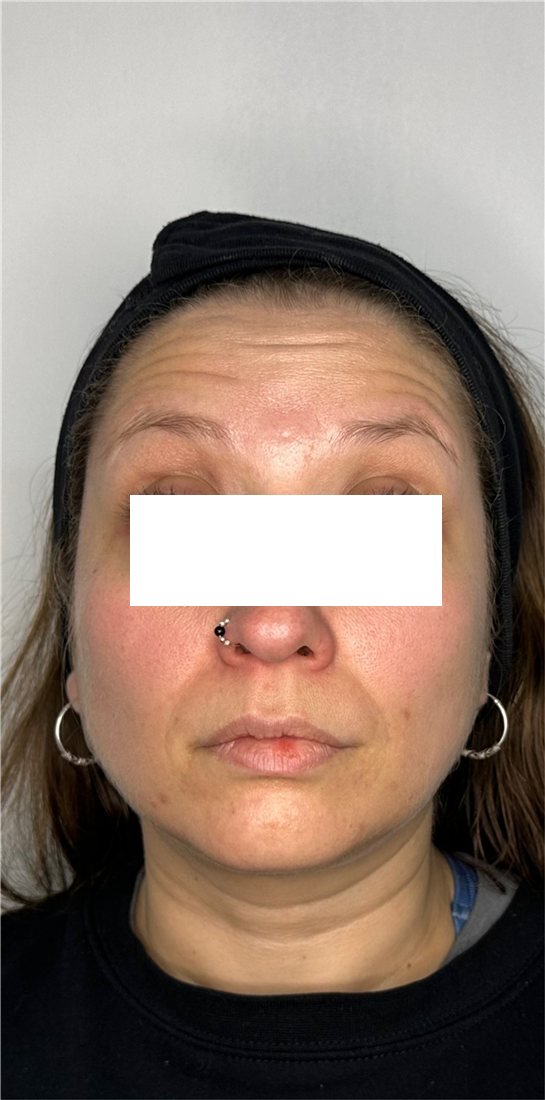 Rostro antes del Botox, líneas de expresión marcadas