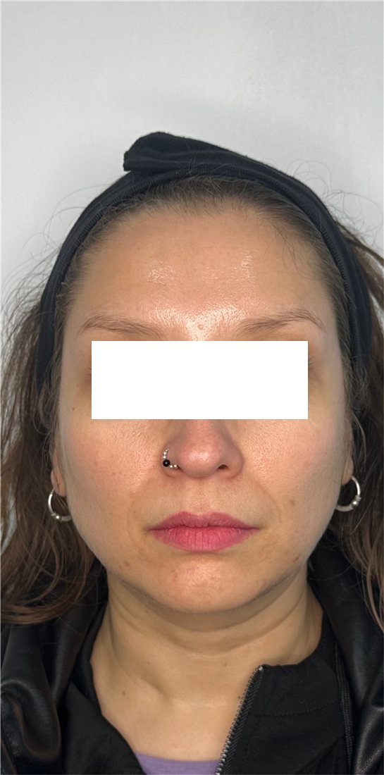Rostro después del Botox, líneas suavizadas con expresión natural