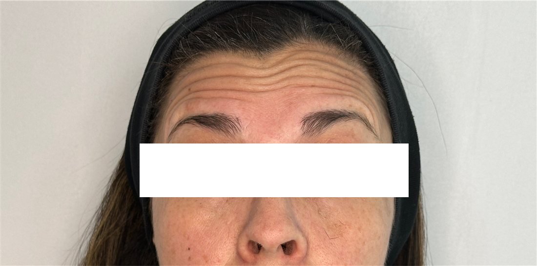 Frente antes del Botox, líneas horizontales al subir las cejas
