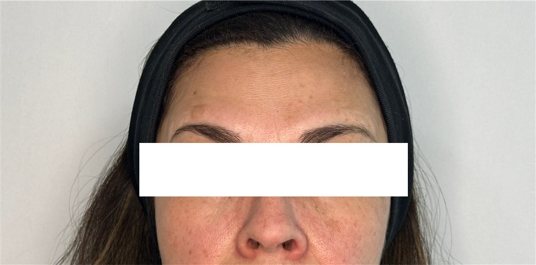 Frente después del Botox, líneas horizontales suavizadas