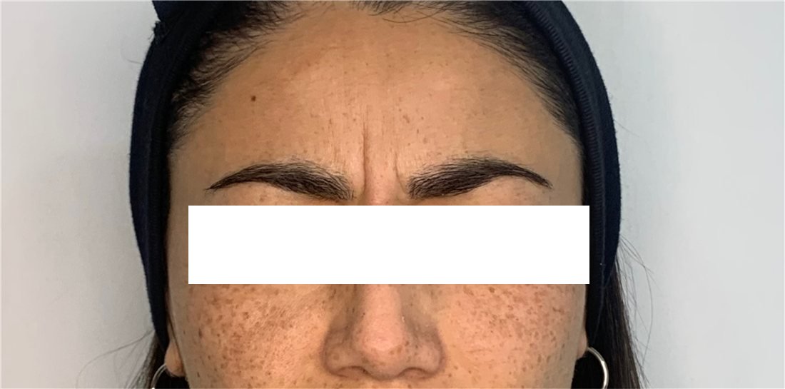 Entrecejo antes del Botox, línea del ceño marcada en máxima contracción