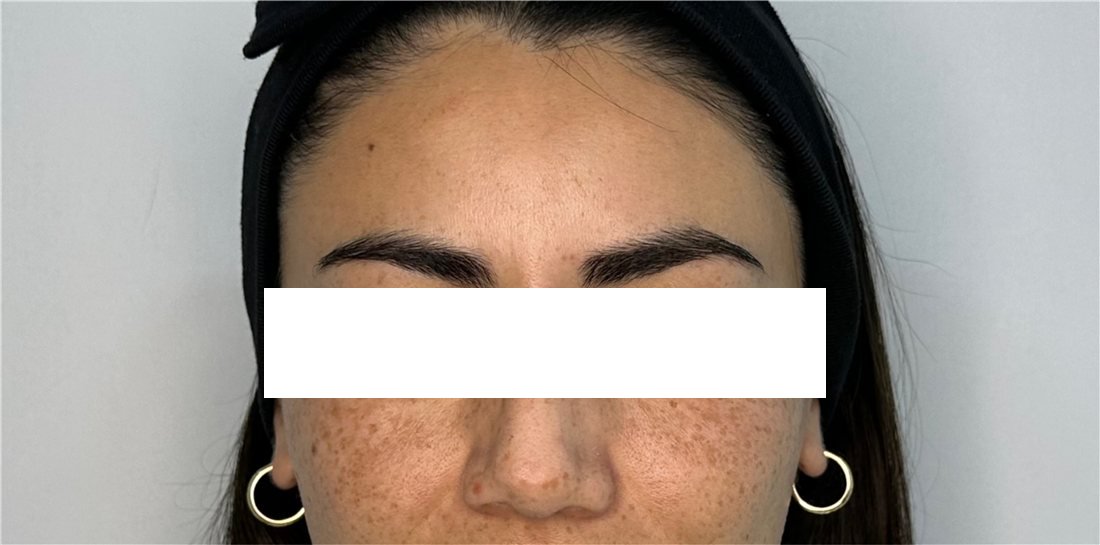 Entrecejo después del Botox, línea del ceño suavizada
