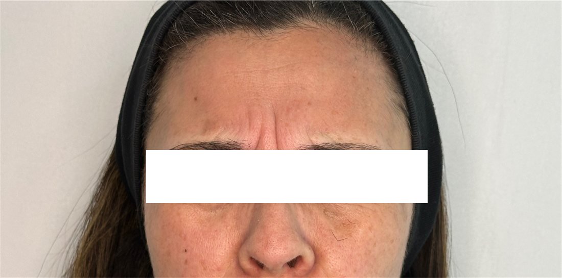 Ceño fruncido con fuerza antes del Botox