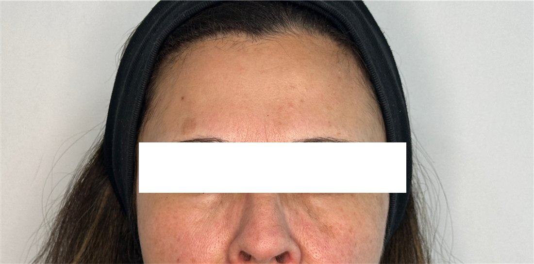 Ceño fruncido después del Botox, músculo relajado y expresión mantenida