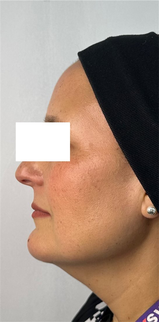 Rostro después de HarmonyCa, perfil