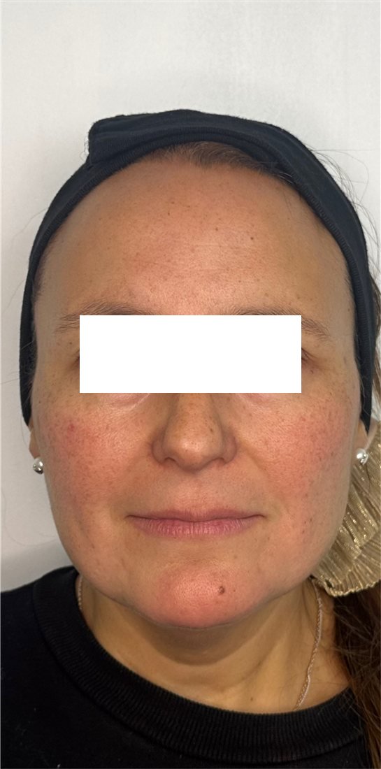 Rostro antes de HarmonyCa, vista frontal