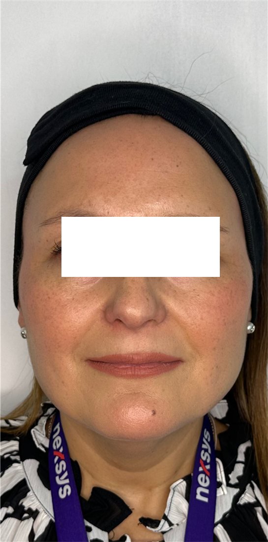 Rostro después de HarmonyCa, vista frontal