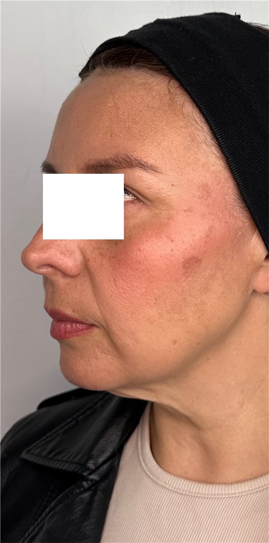 Rostro antes de los hilos tensores PDO