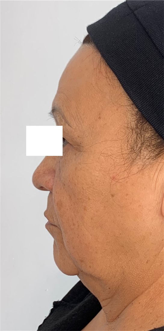 Perfil antes de los hilos tensores