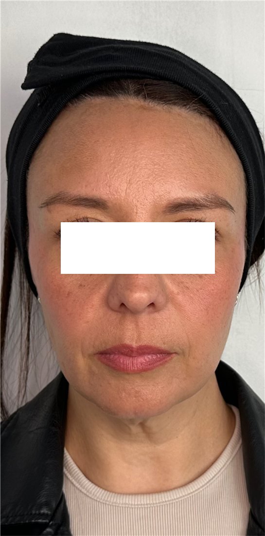 Rostro antes de los hilos tensores, vista frontal