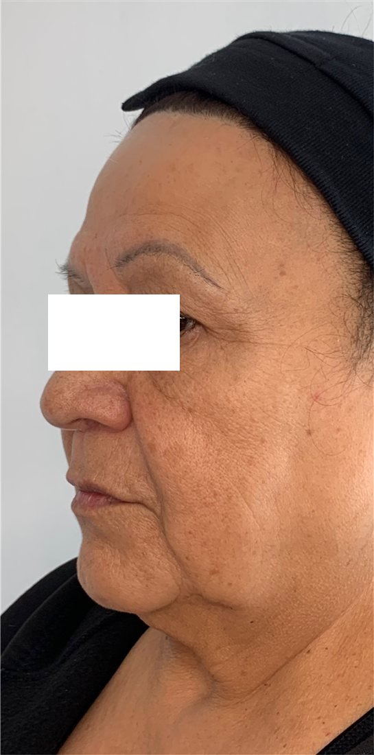 Rostro antes del reposicionamiento con hilos tensores