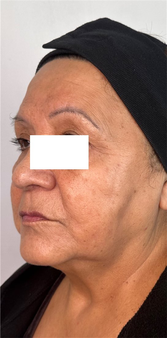 Rostro después del reposicionamiento con hilos tensores